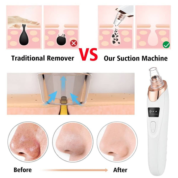 Electric Blackhead Remover - Vacuum Suction